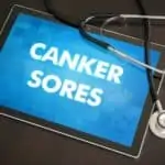 canker sore